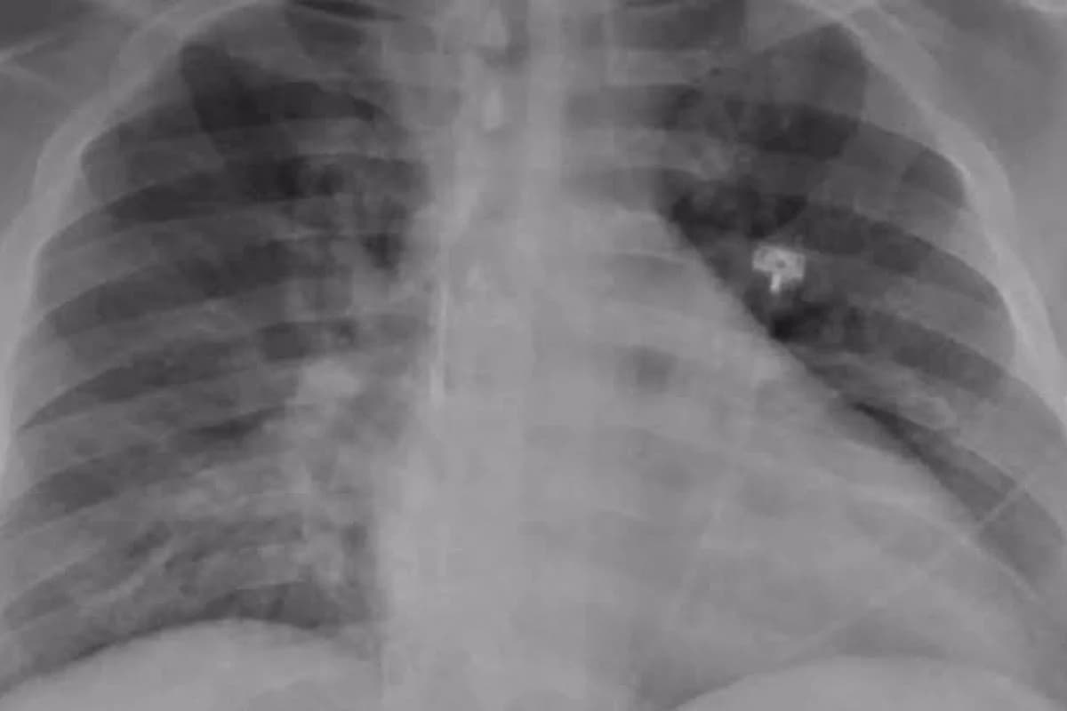 Vigilan neumonía necrotizante tras caso en Rusia; Médicos de Aguascalientes advierten sobre el daño pulmonar - imagen de origen